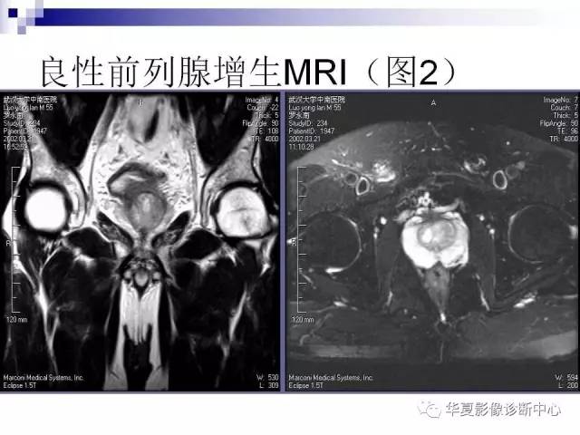 【PPT】前列腺癌的MRI诊断