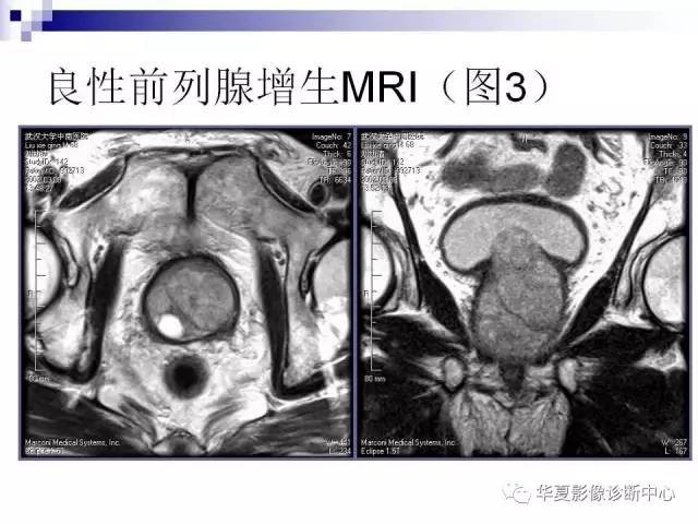 【PPT】前列腺癌的MRI诊断