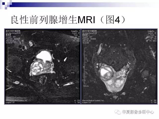 【PPT】前列腺癌的MRI诊断