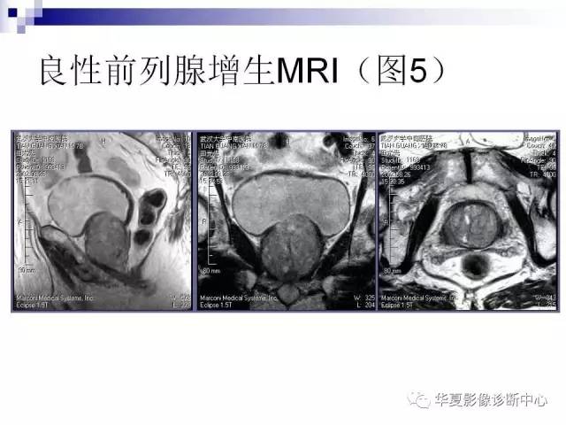 【PPT】前列腺癌的MRI诊断