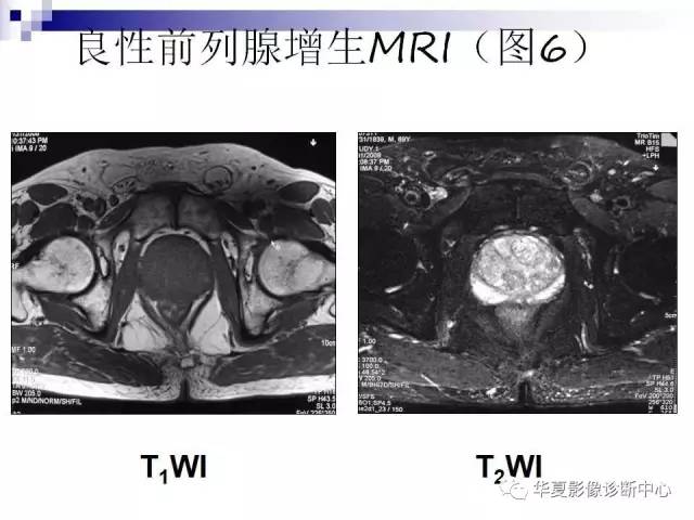 【PPT】前列腺癌的MRI诊断