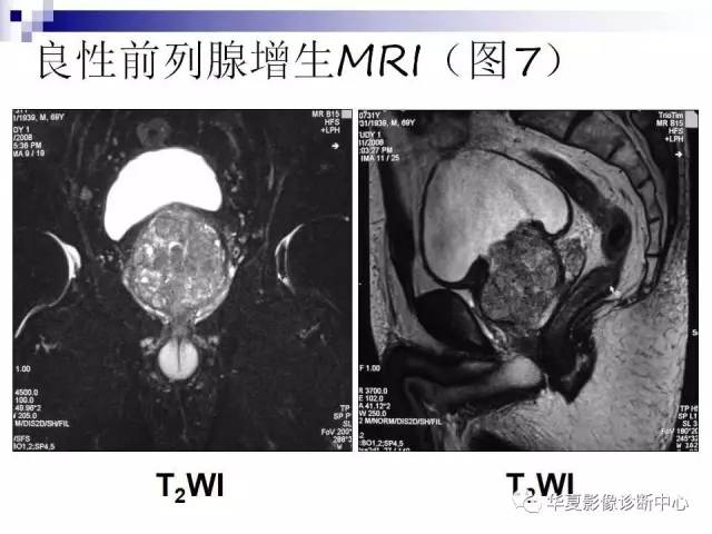 【PPT】前列腺癌的MRI诊断