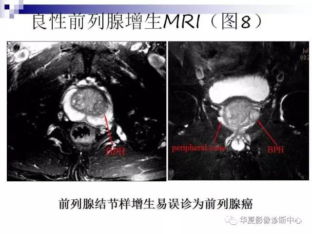 【PPT】前列腺癌的MRI诊断