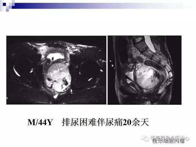 【PPT】前列腺癌的MRI诊断