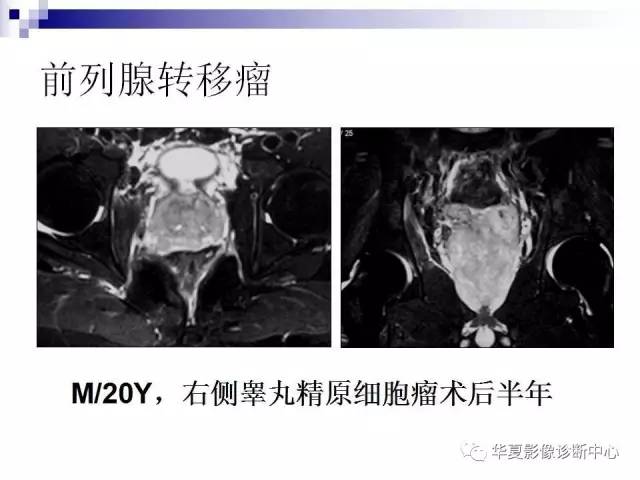 【PPT】前列腺癌的MRI诊断