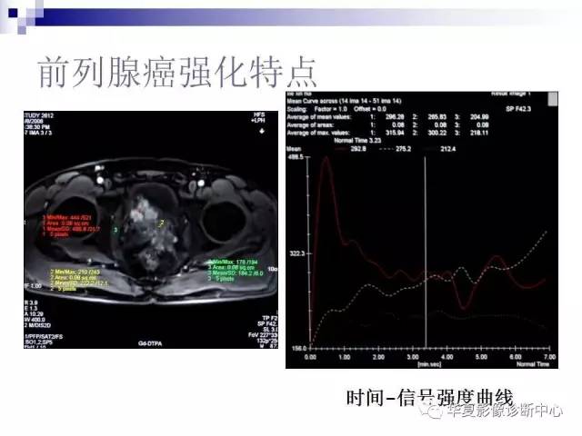 【PPT】前列腺癌的MRI诊断