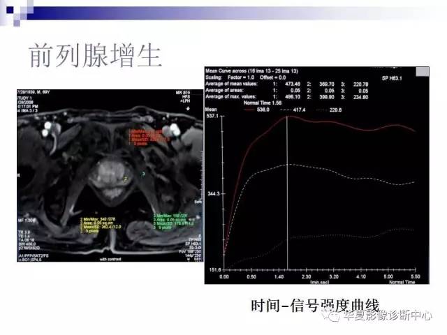 【PPT】前列腺癌的MRI诊断