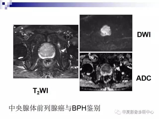【PPT】前列腺癌的MRI诊断