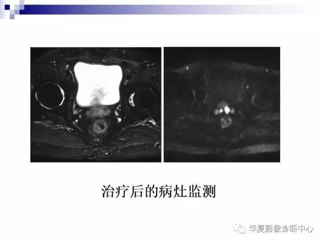 【PPT】前列腺癌的MRI诊断