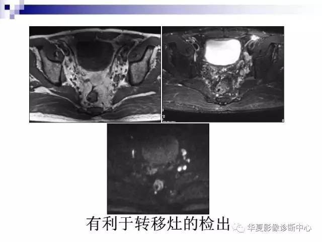 【PPT】前列腺癌的MRI诊断
