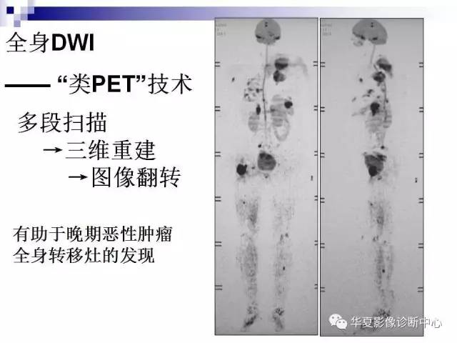 【PPT】前列腺癌的MRI诊断