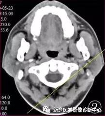 腮腺区异常,要想到的15种疾病 腮腺区异常,要想到的15种疾病