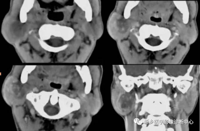 腮腺区异常,要想到的15种疾病 腮腺区异常,要想到的15种疾病