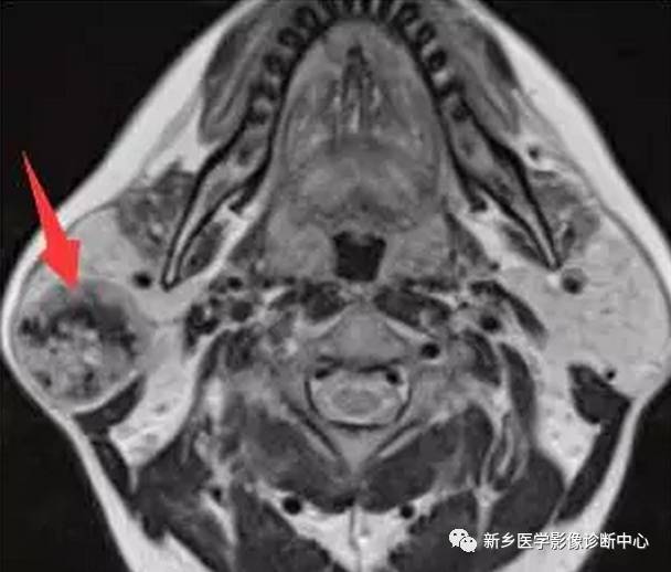 腮腺区异常，要想到的15种疾病
