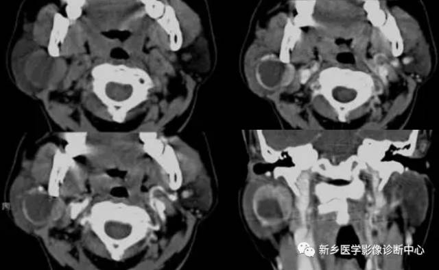 腮腺区异常,要想到的15种疾病 腮腺区异常,要想到的15种疾病