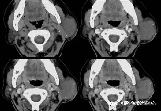 腮腺区异常,要想到的15种疾病 腮腺区异常,要想到的15种疾病