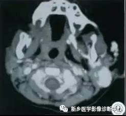 腮腺区异常,要想到的15种疾病 腮腺区异常,要想到的15种疾病