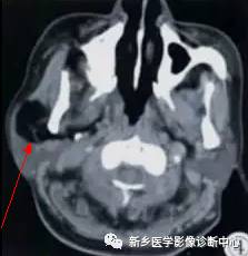 腮腺区异常,要想到的15种疾病 腮腺区异常,要想到的15种疾病