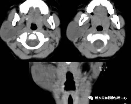 腮腺区异常,要想到的15种疾病 腮腺区异常,要想到的15种疾病