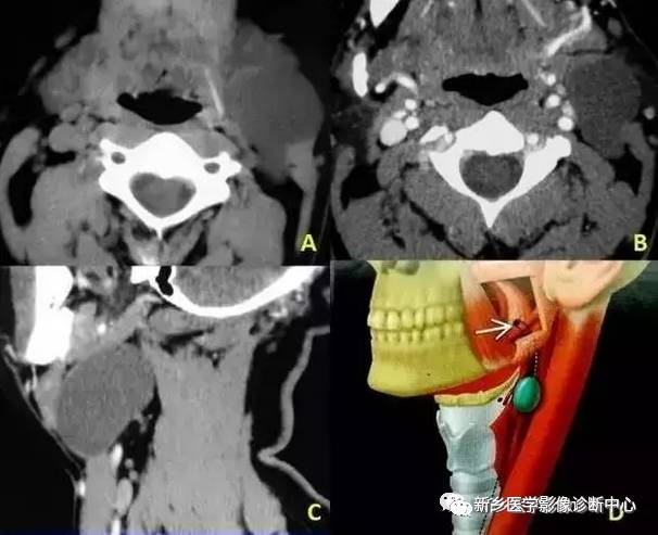腮腺区异常,要想到的15种疾病 腮腺区异常,要想到的15种疾病