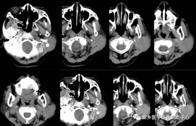 腮腺区异常,要想到的15种疾病 腮腺区异常,要想到的15种疾病
