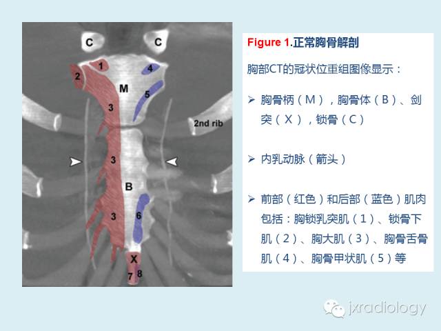 【PPT】胸骨及胸锁关节病变【RG精选】