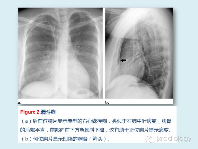 【PPT】胸骨及胸锁关节病变【RG精选】