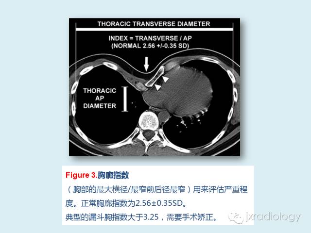 【PPT】胸骨及胸锁关节病变【RG精选】
