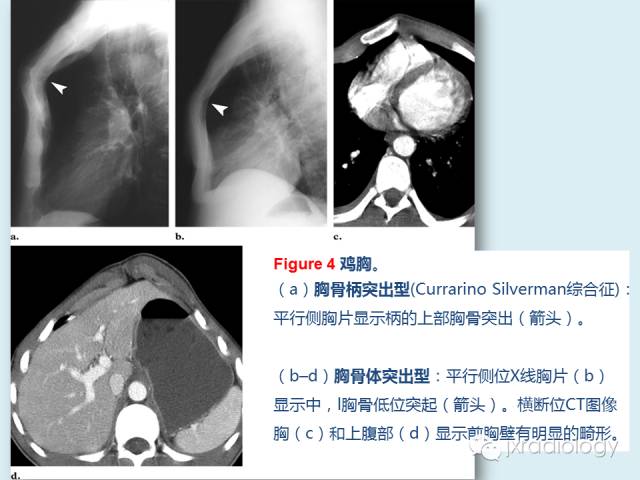 【PPT】胸骨及胸锁关节病变【RG精选】