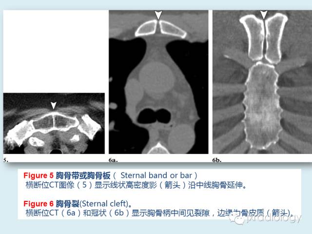 【PPT】胸骨及胸锁关节病变【RG精选】