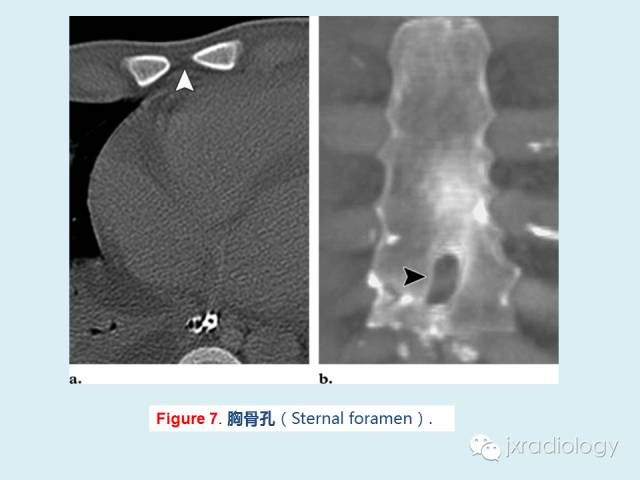 【PPT】胸骨及胸锁关节病变【RG精选】
