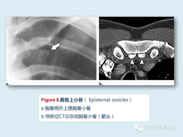 【PPT】胸骨及胸锁关节病变【RG精选】