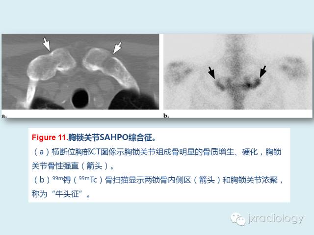 【PPT】胸骨及胸锁关节病变【RG精选】