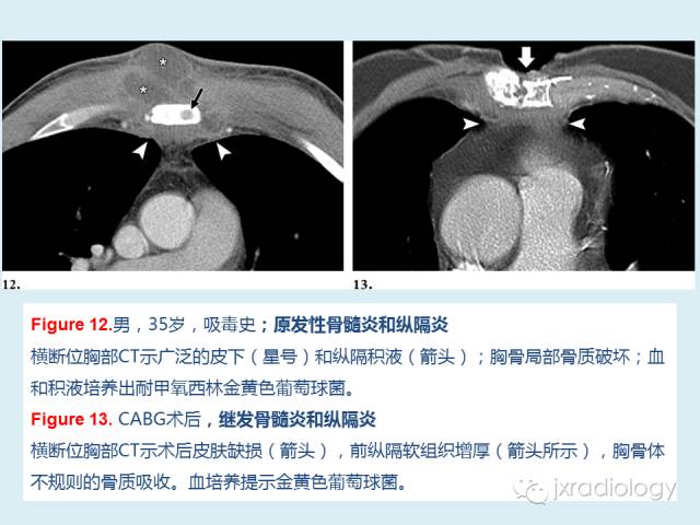 【PPT】胸骨及胸锁关节病变【RG精选】