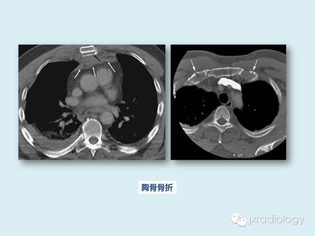 【PPT】胸骨及胸锁关节病变【RG精选】