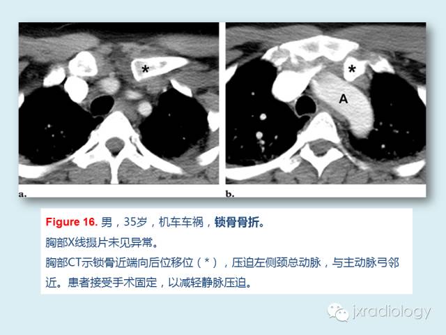 【PPT】胸骨及胸锁关节病变【RG精选】