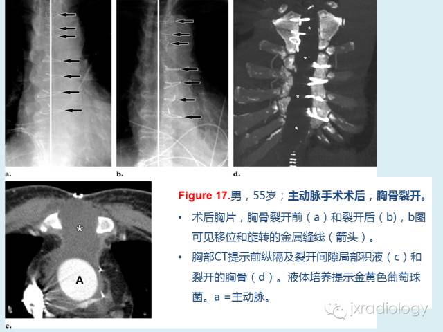 【PPT】胸骨及胸锁关节病变【RG精选】