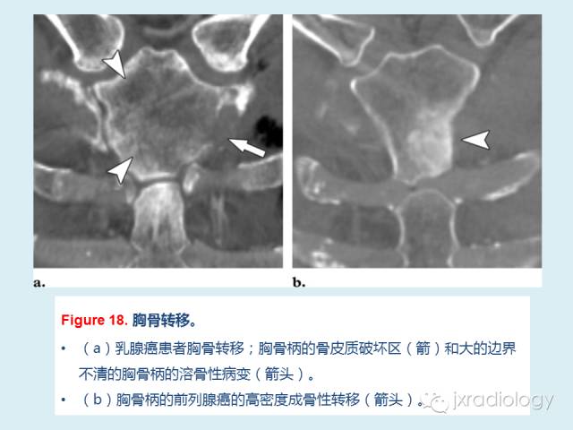【PPT】胸骨及胸锁关节病变【RG精选】