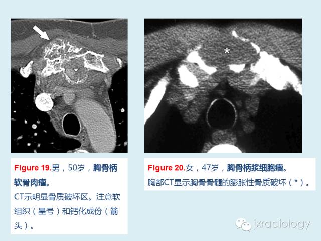 【PPT】胸骨及胸锁关节病变【RG精选】