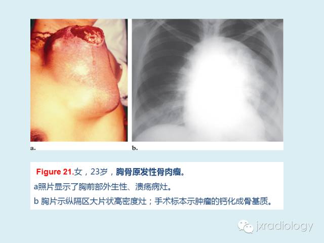 【PPT】胸骨及胸锁关节病变【RG精选】