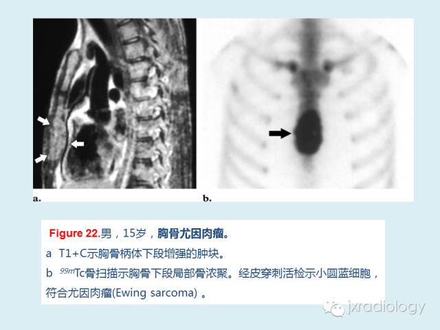 【PPT】胸骨及胸锁关节病变【RG精选】