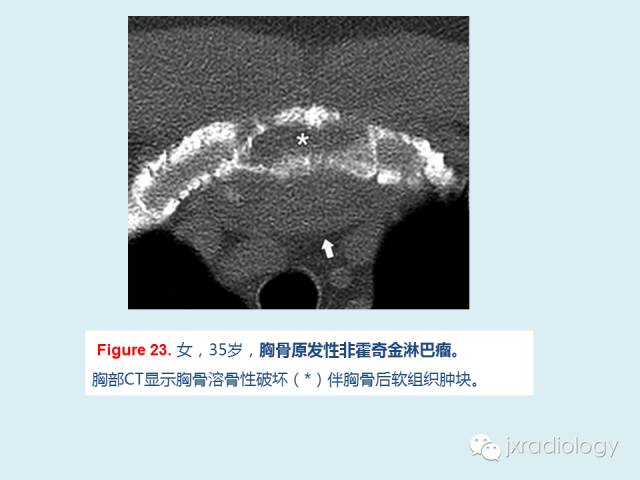 【PPT】胸骨及胸锁关节病变【RG精选】