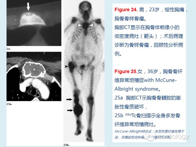 【PPT】胸骨及胸锁关节病变【RG精选】