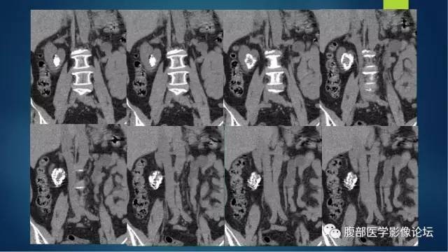 【病例】右肾透明细胞癌伴钙化1例CT及MR