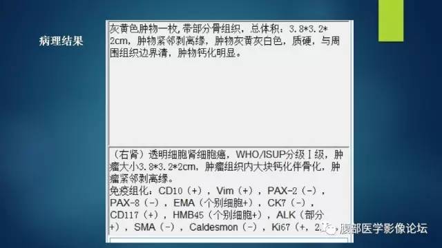 【病例】右肾透明细胞癌伴钙化1例CT及MR