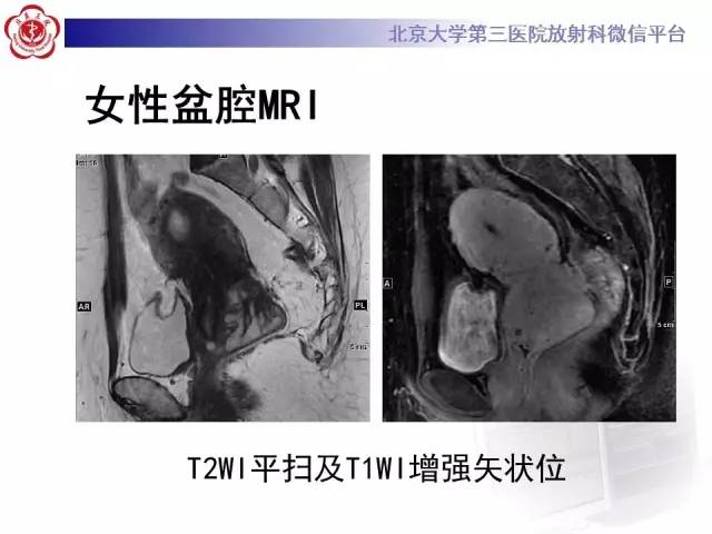 【病例】宫颈子宫内膜异位症(深部浸润型)1例MR