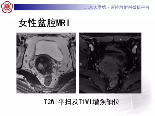 【病例】宫颈子宫内膜异位症(深部浸润型)1例MR