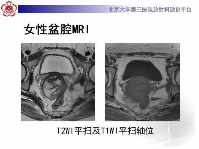 【病例】宫颈子宫内膜异位症(深部浸润型)1例MR