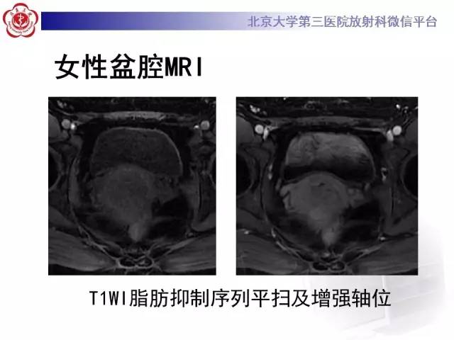 【病例】宫颈子宫内膜异位症(深部浸润型)1例MR