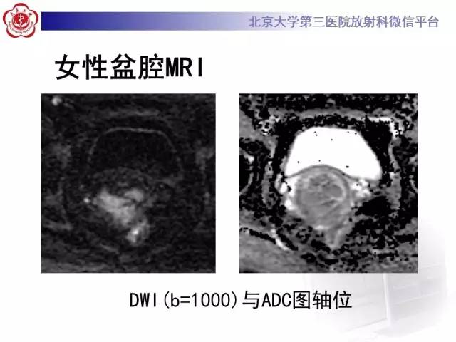 【病例】宫颈子宫内膜异位症(深部浸润型)1例MR
